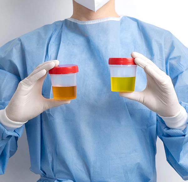 Urine Bilirubin Test: Normal Range and What Abnormal Results Mean