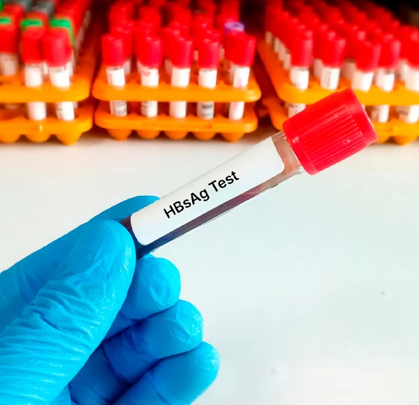 HBsAg Test: What It Is, Why It Is Done, and Result Interpretation