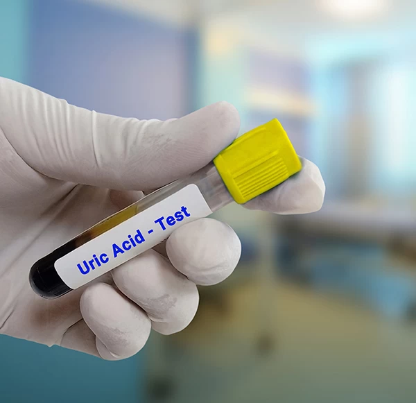 Uric Acid Test: Causes of High Levels and Gout Risk