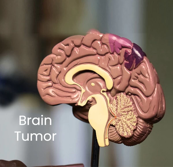 From Headache to Diagnosis: How to spot a Brain Tumor early