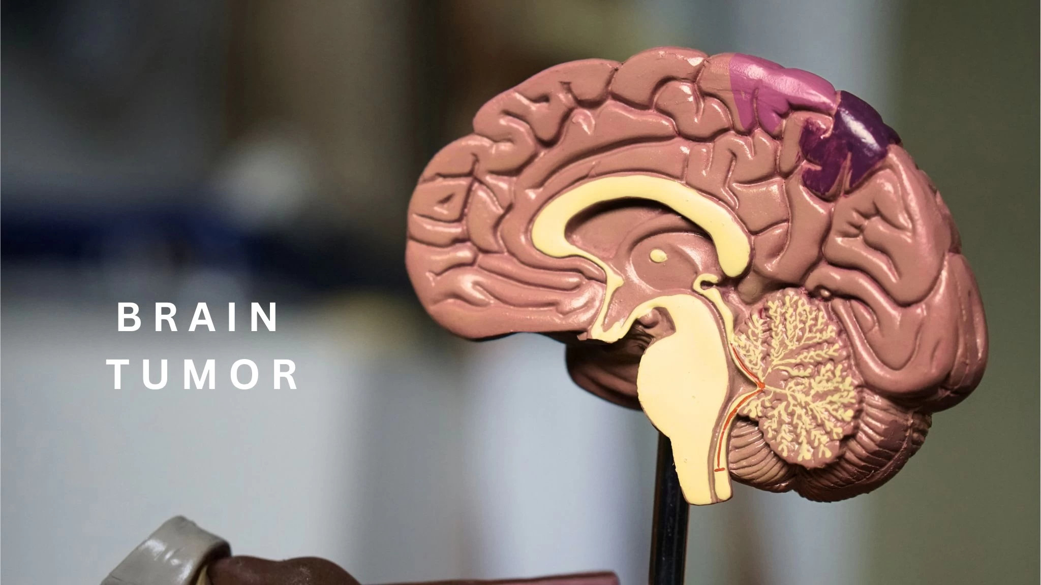 From Headache to Diagnosis: How to spot a Brain Tumor early
