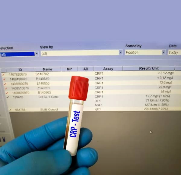CRP Test: Decoding the Normal Range