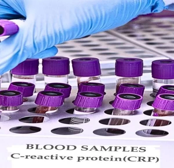 CRP Blood Test: What It Reveals About Your Health And How To Manage Elevated Levels
