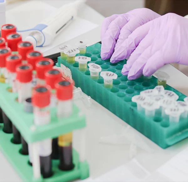Beyond the numbers: Unlocking the secrets of your Lipid Profile Test