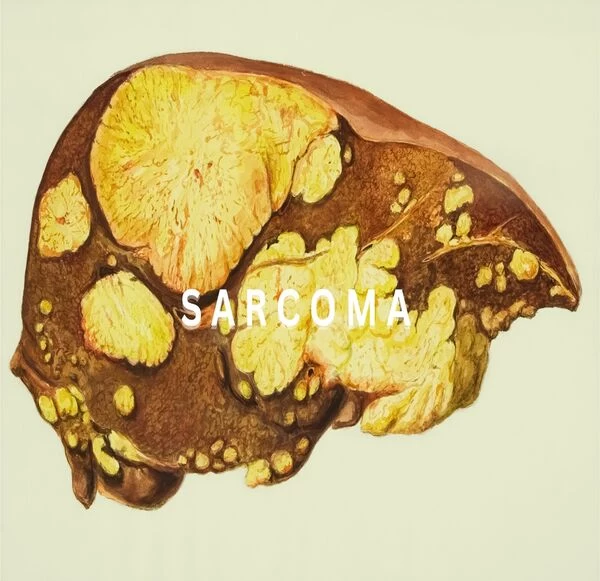 Unmasking Sarcoma: Types, Symptoms, and the power of Early Detection