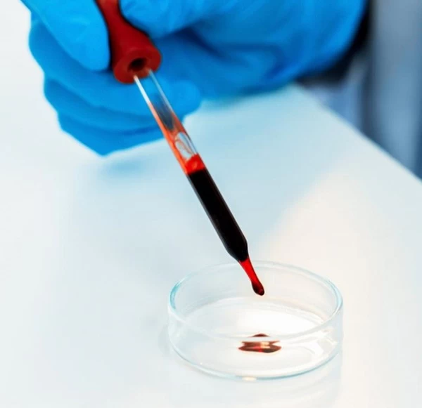 Scleroderma Blood Tests: ANA and Autoimmune Markers Explained