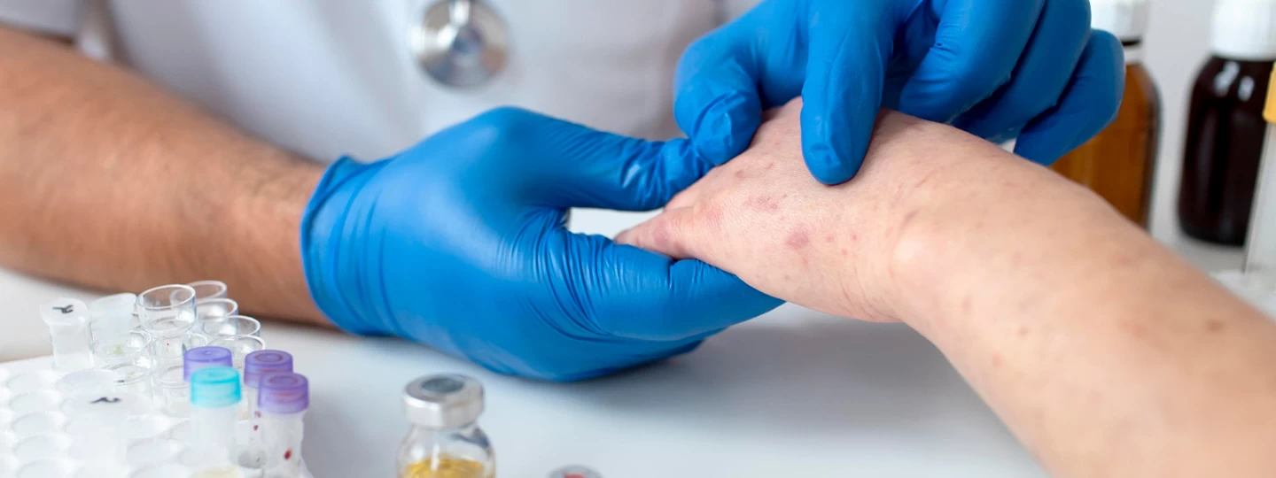 Lupus Symptoms in Women and Men: Causes, Diagnosis, and Treatment Approach