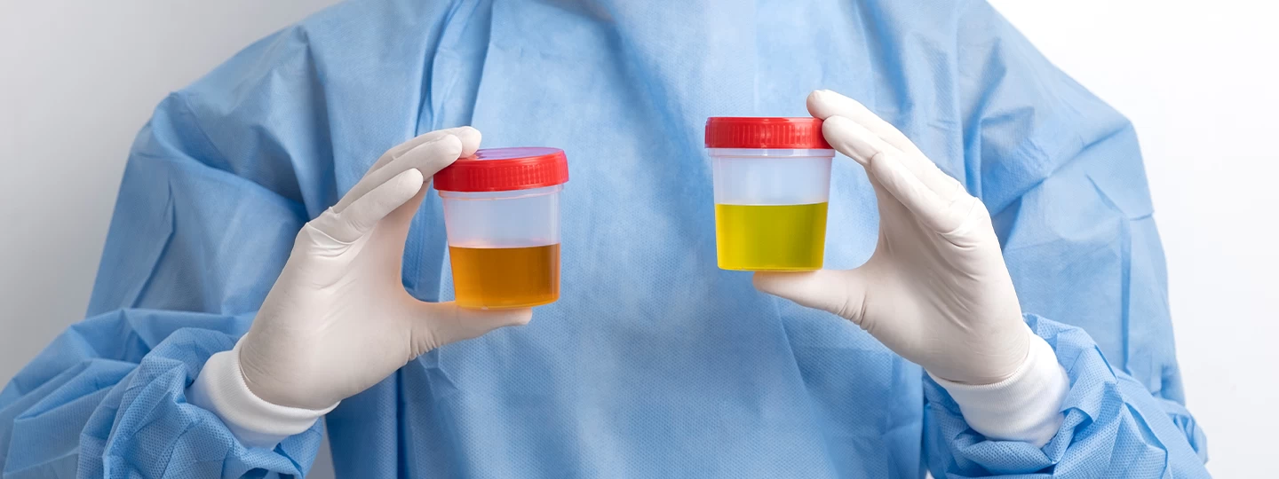 Urine Bilirubin Test: Normal Range and What Abnormal Results Mean