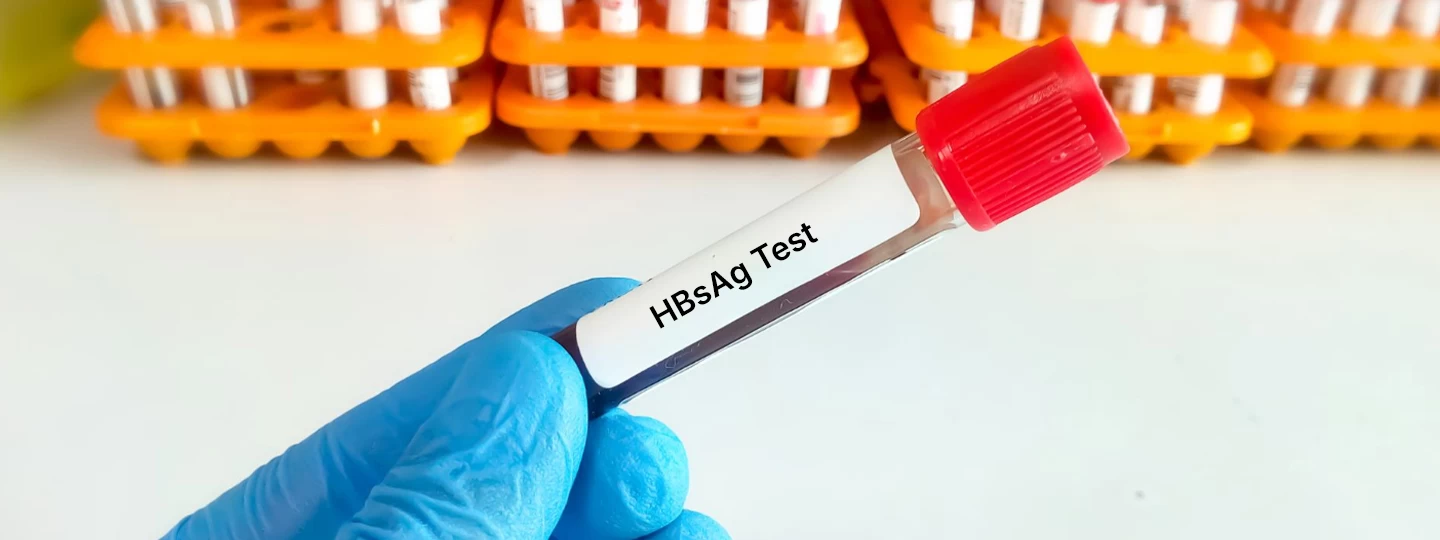 HBsAg Test: What It Is, Why It Is Done, and Result Interpretation