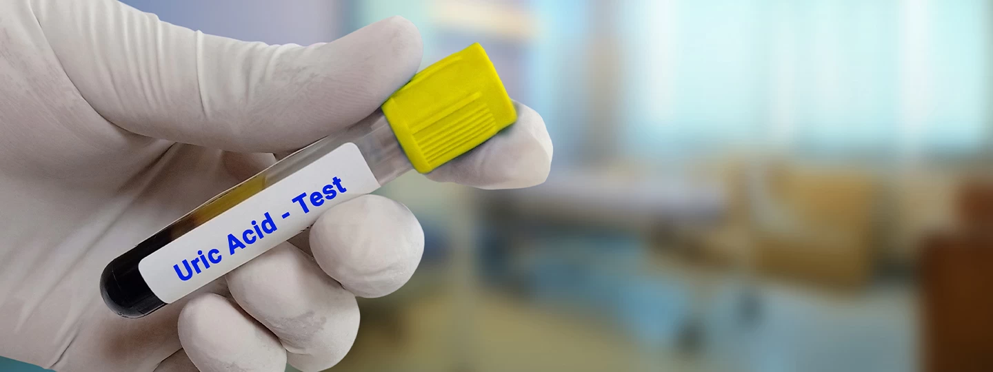 Uric Acid Test: Causes of High Levels and Gout Risk