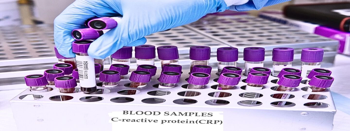 CRP Blood Test: What It Reveals About Your Health And How To Manage Elevated Levels