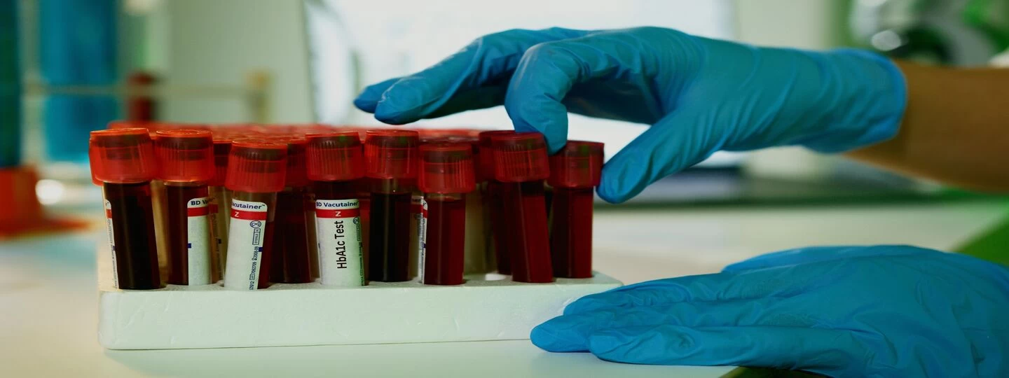 Decoding HbA1c: A key marker for diabetes management