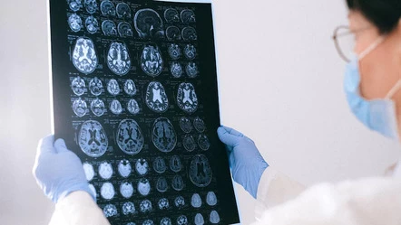 Early Alzheimer's Detection: New Blood Biomarker Test With Imaging Shows Promise